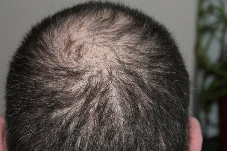 The Reality Of CBD For Hair Loss: Any Truth Or Just Myth?